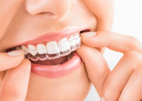 Benifits of Aligners